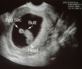 Sagan Ultrasound 14 Weeks into Pregnancy