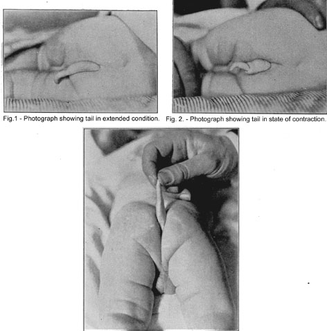 Atavistic Tail in Human Infant