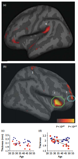 Cortical Thickening in Meditators