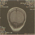 Ryan's MRI: Front View of the Head