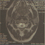 Ryan's MRI: Top View of Neck and Chest