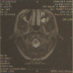 Ryan's MRI: Top View of the Head