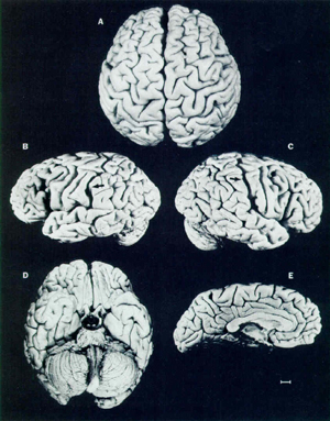 Photographs of Albert Einstein's brain, taken in 1955